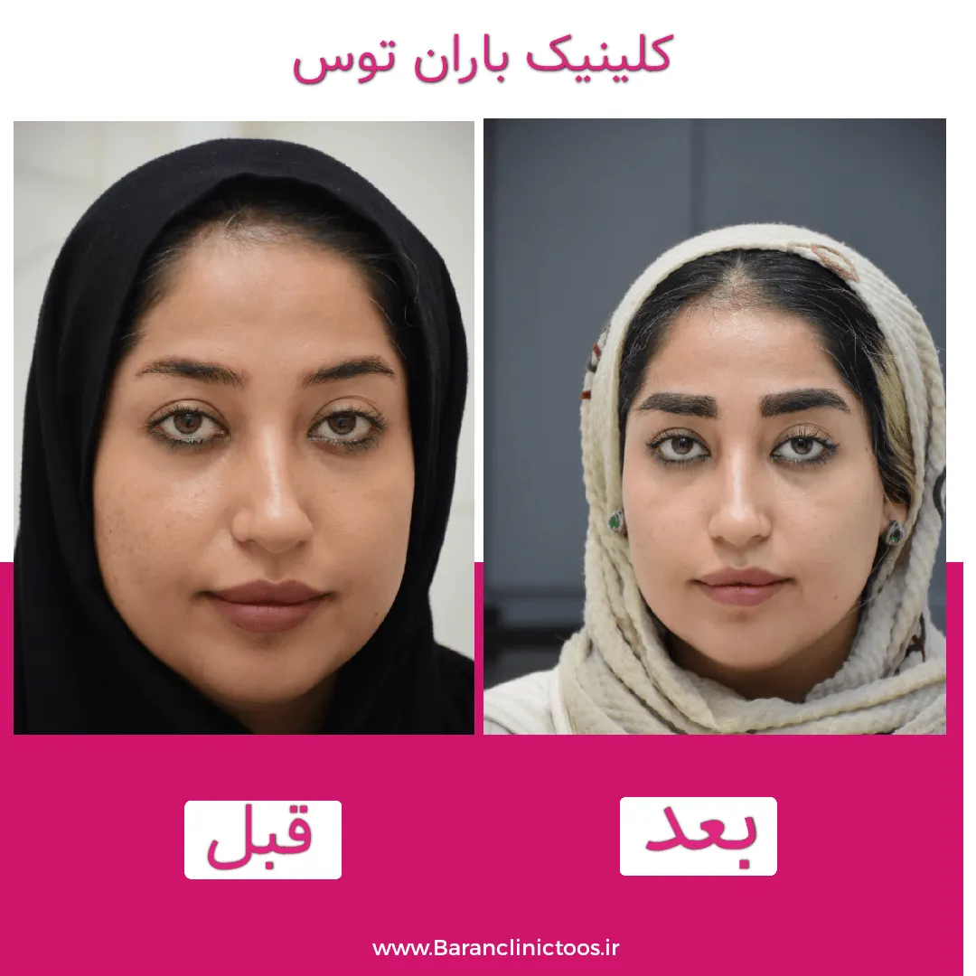 قبل و بعد کاشت ابرو